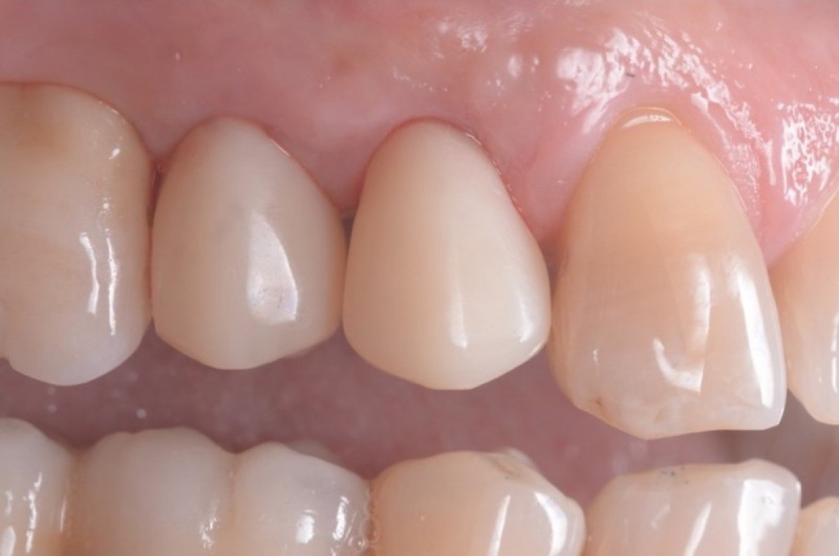 Figure 22: Vestibular image of screw-retained temporary crowns, delivered the same day of surgery