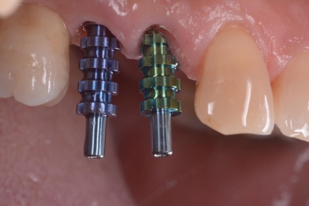 Figure 23: At 5 months from the surgery the impression is taken with Pick-up transfer