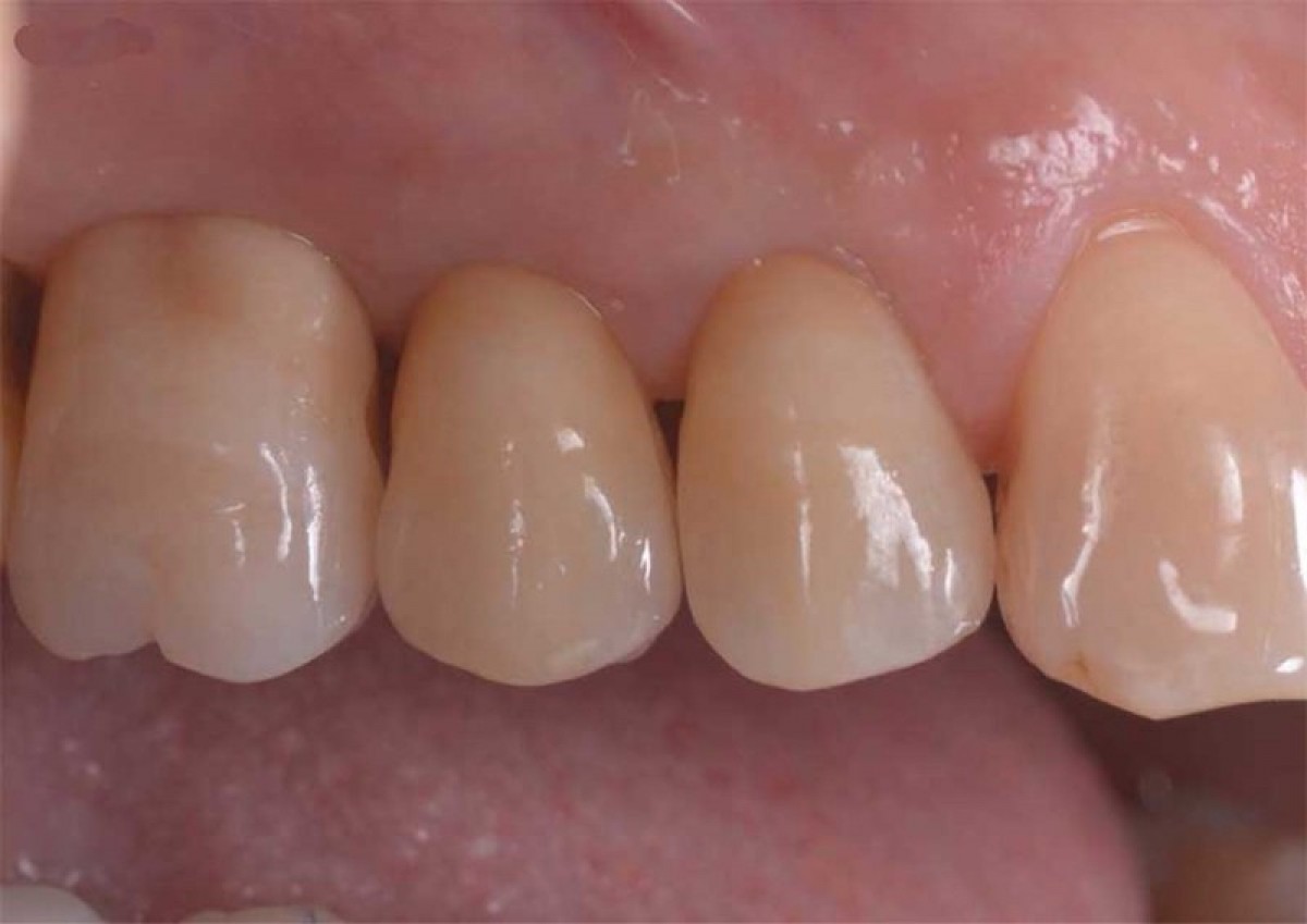 Figure 24: Delivery of the final crowns after 1 month. it is possible to notice the excellent state of health of the soft tissues