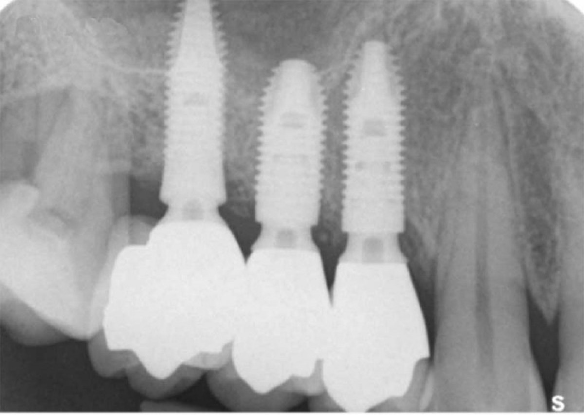 Figure 25: Rx of control: on the element 16 it is possible to note the completion of the implant integration, while on the elements 14 and 15 the good bone growth around the three different neck morphologies is visible