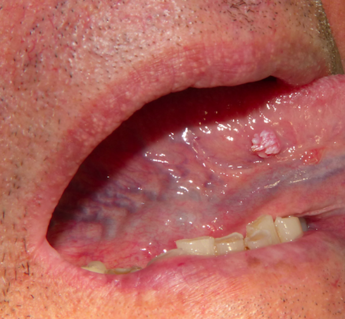 Papilloma in the tongue
