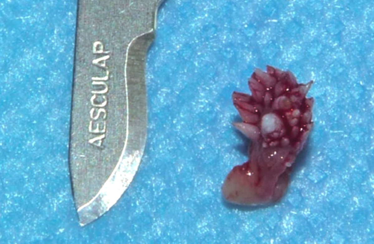 Figure 2: Total excision of the lesion