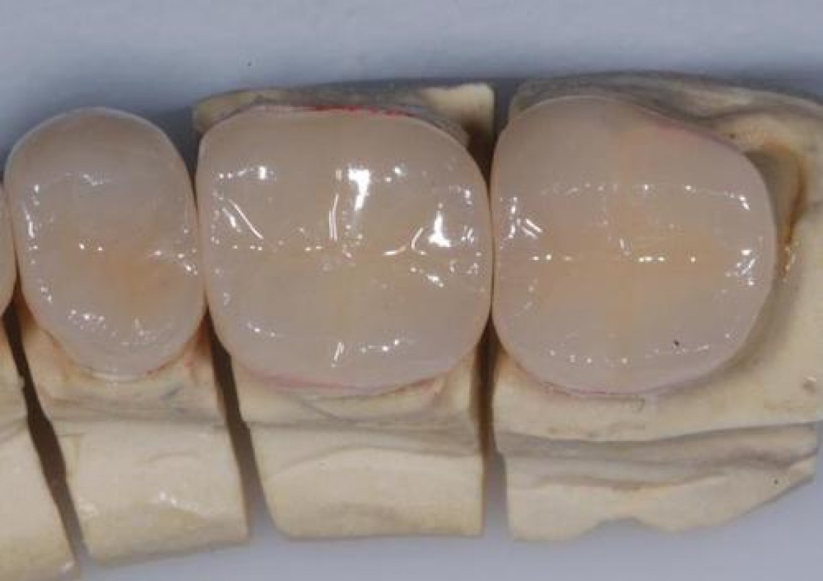 https://www.dentistry33.com/upload/20190214171721Restauri.jpeg