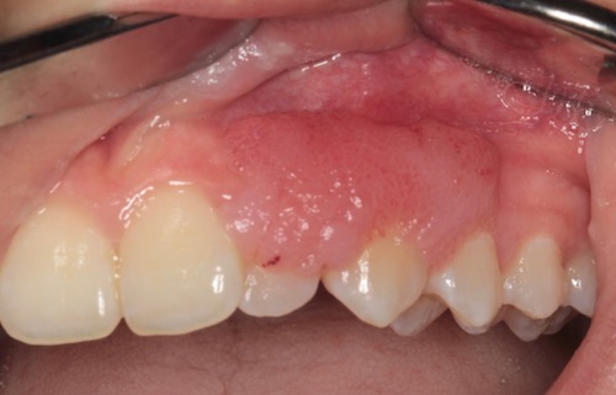 Hpv gum cancer Mouth warts on gums