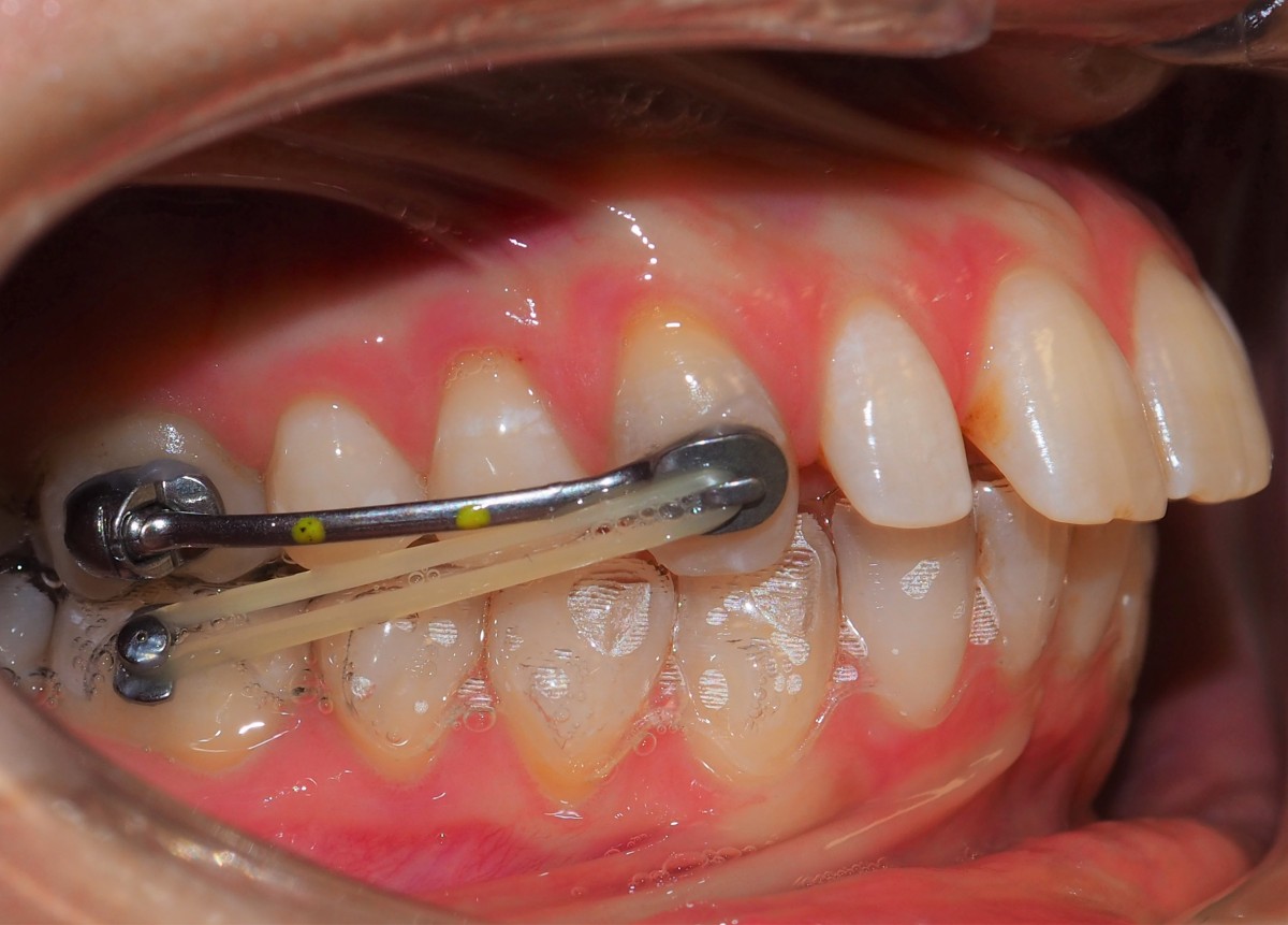 Effects Of The Carriere Motion 3D Appliance Dentistry33