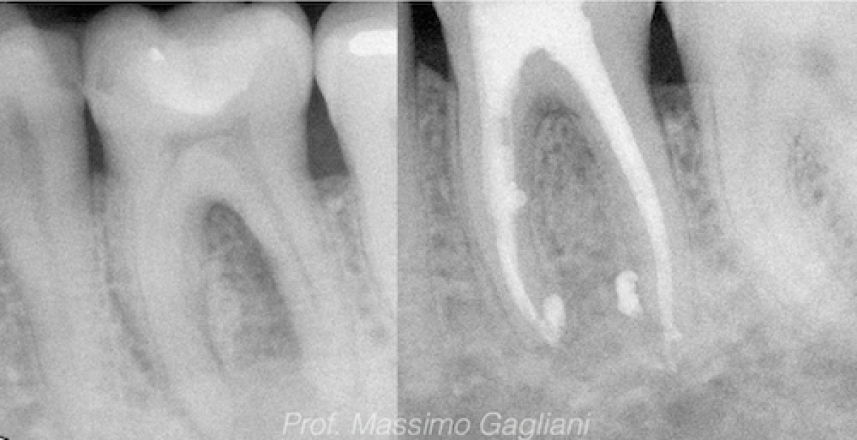 A new systematic for endodontic treatment in teeth with necrotic pulp