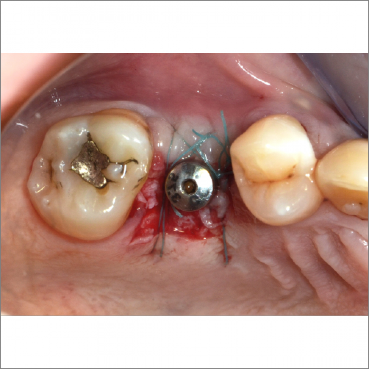 ROLE AND UTILITY OF THE KERATINIZED MUCOSA AROUND DENTAL IMPLANTS