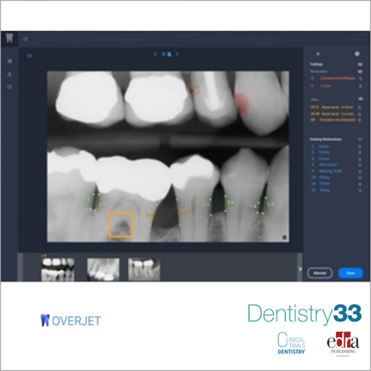 Overjet raises 27M Dentistry33