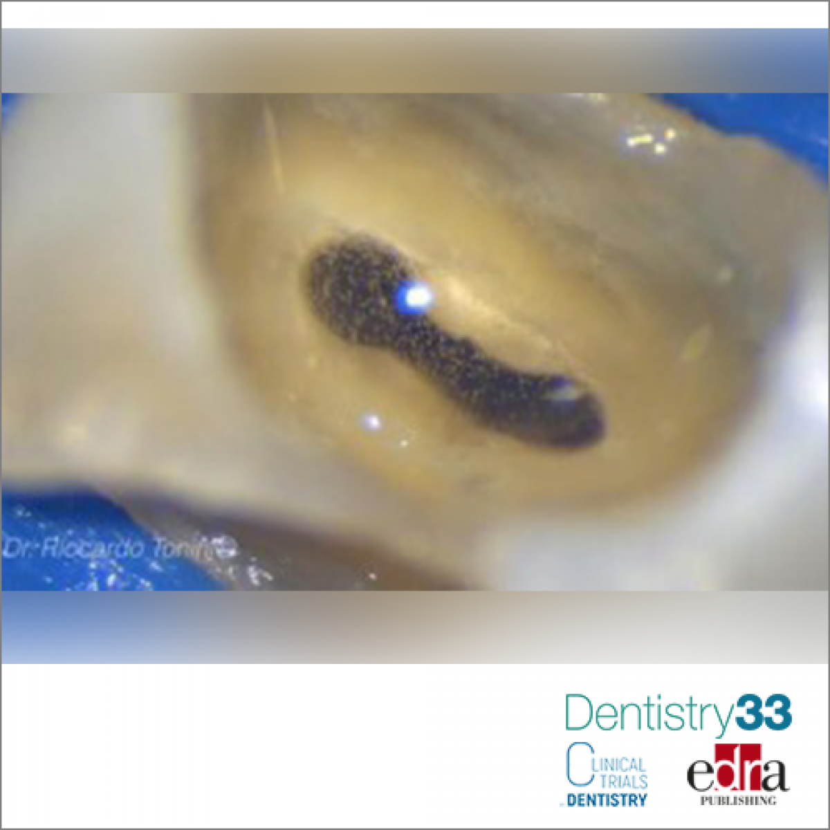 What is the best obturation technique for ovalshaped canals? Dentistry33