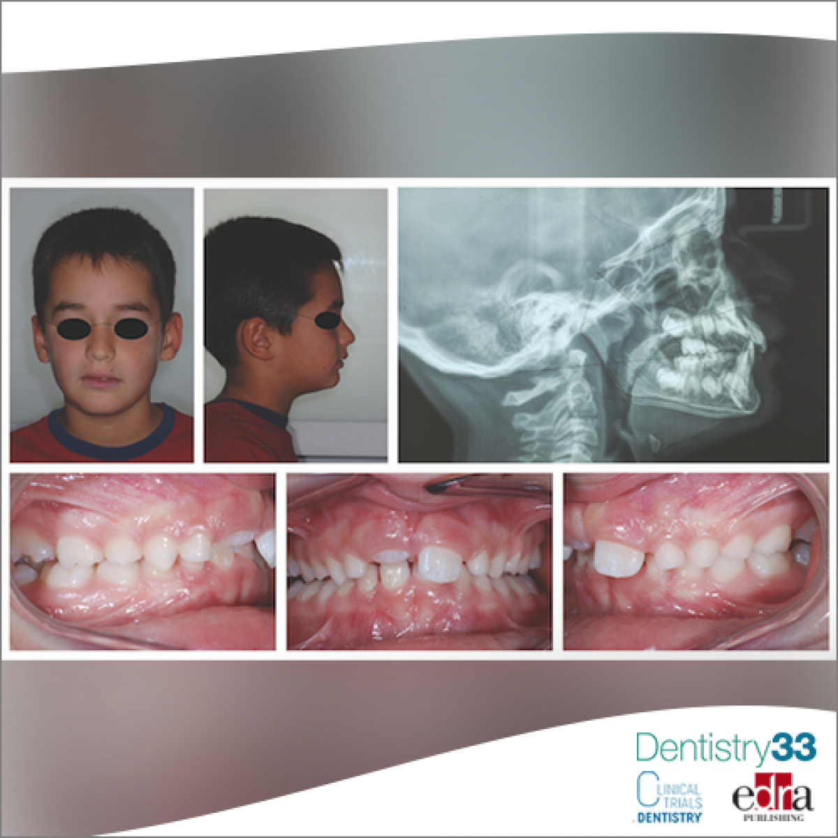 Interceptive orthodontic treatment with elastomeric appliances