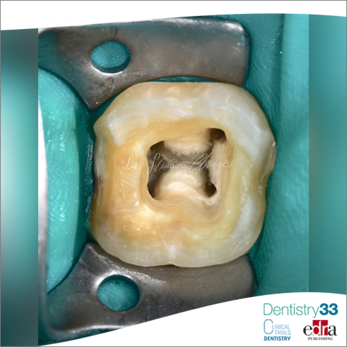 Minimally invasive access cavity and reduced root canal shaping how do