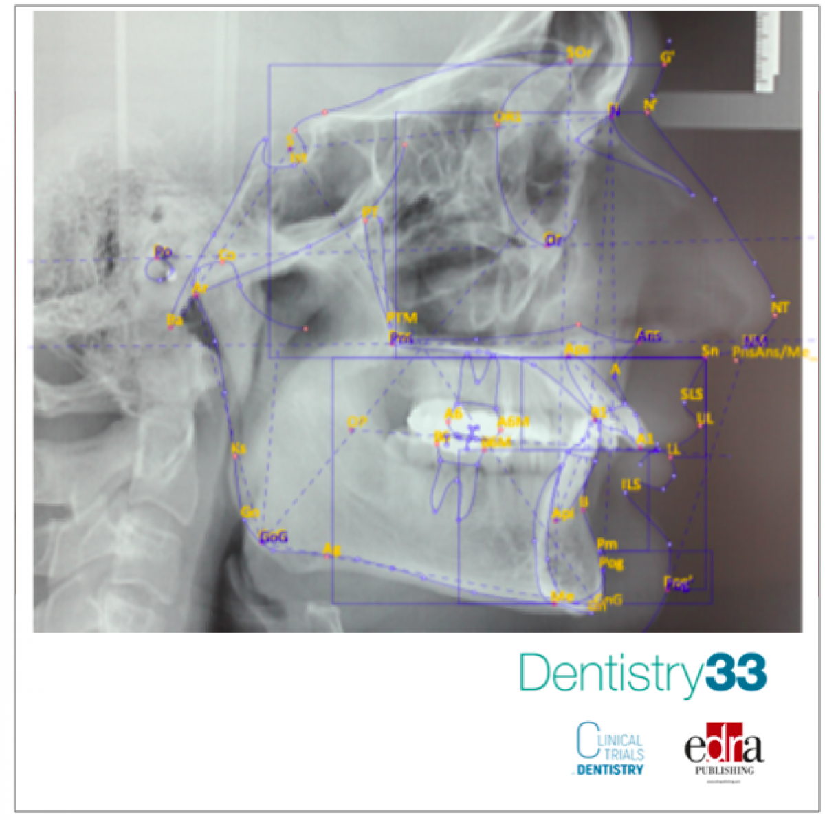 Orthodonticsurgical treatment of a severe class II skeletal
