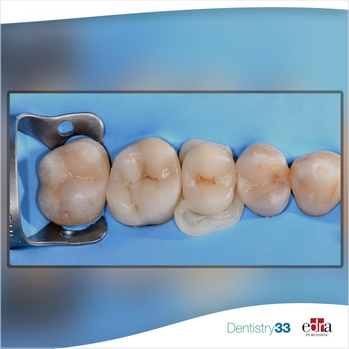 Resin composite blocks for indirect restoration which material to