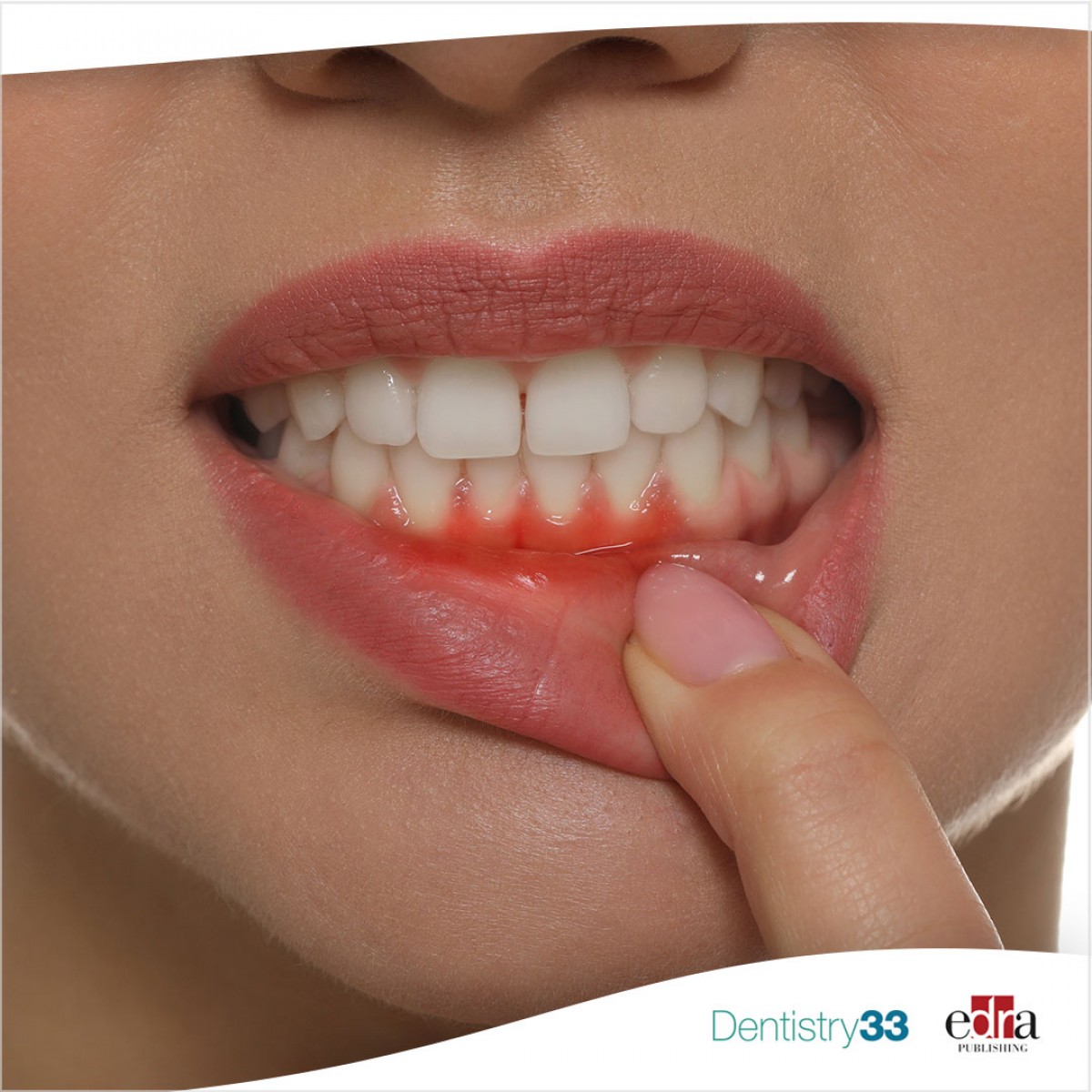 Epulides factors associated with their recurrence Dentistry33