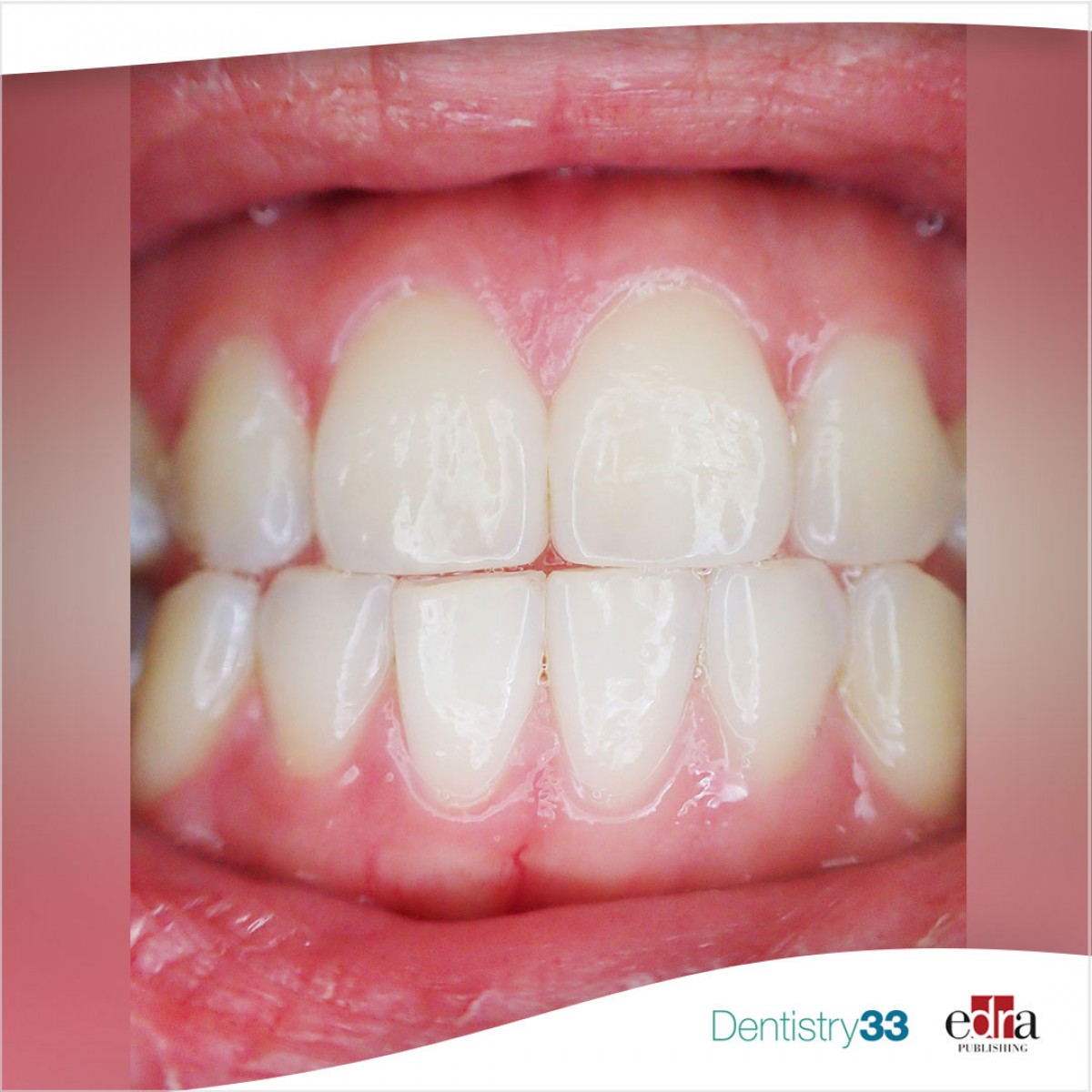 Dental epulis factors associated with its recurrence Dentistry33
