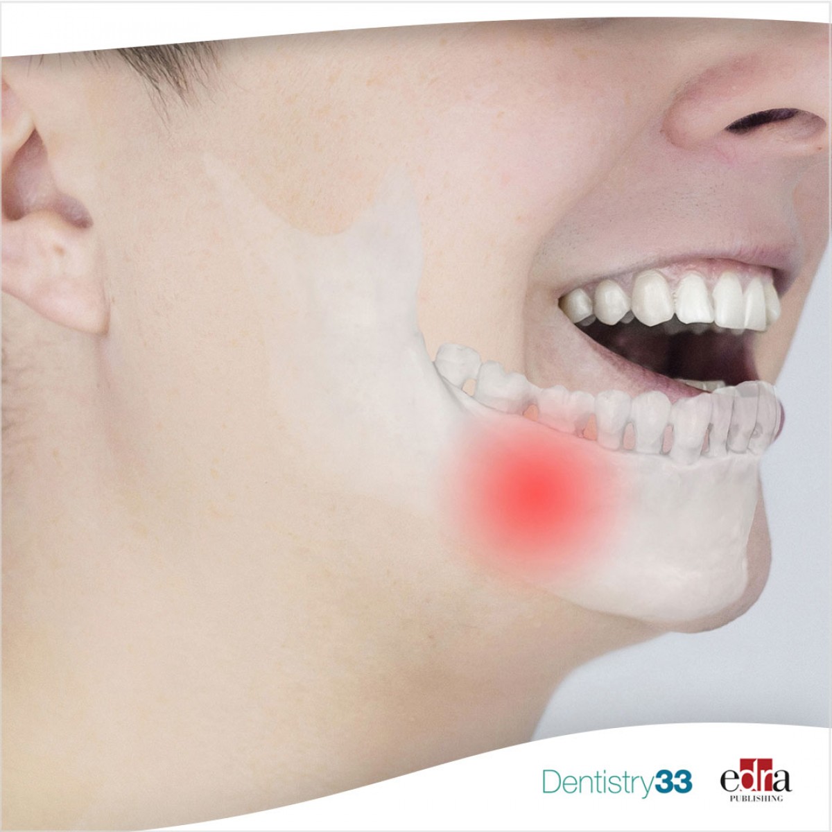 Yes or no antibiotics in the surgical treatment of mandibular