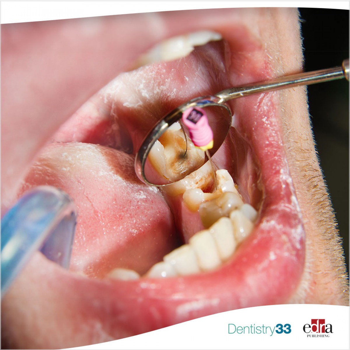 Endodontic regeneration procedure in nonvital immature teeth Dentistry33
