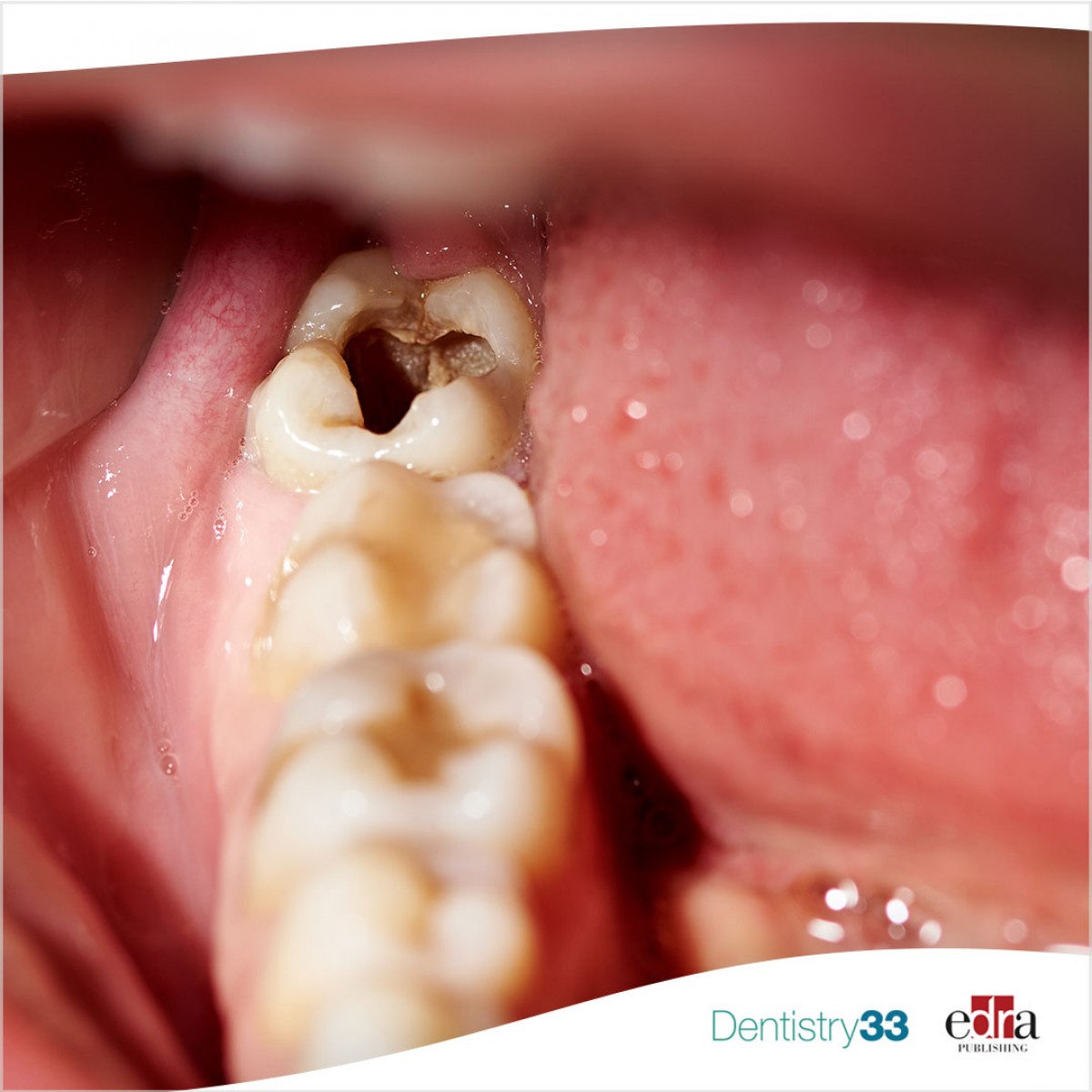 Penn Dental Medicine, UNC study identifies new bacterial species in