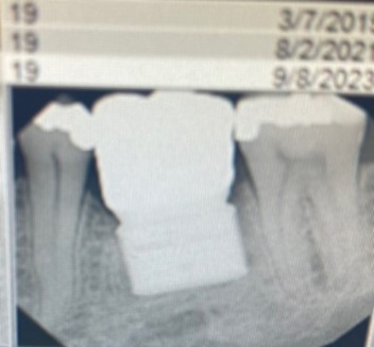 The Proximerge 2 dental implant. Photos: Dr. James Grant 