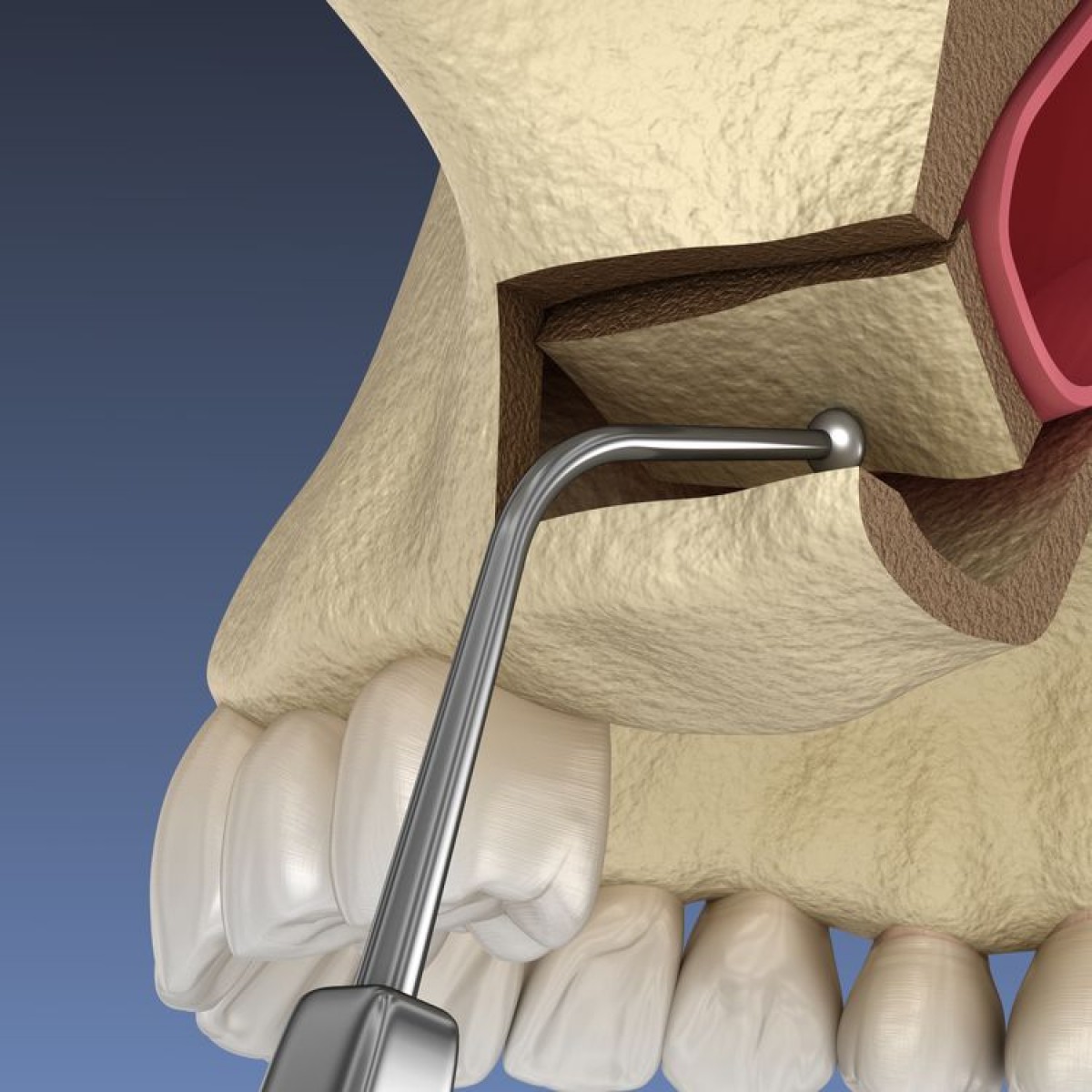 thumbnail image 2 of Maxillary Sinus Lift Practice Model – Dental Training Education – HANZE Typodont Teeth 2 of 6