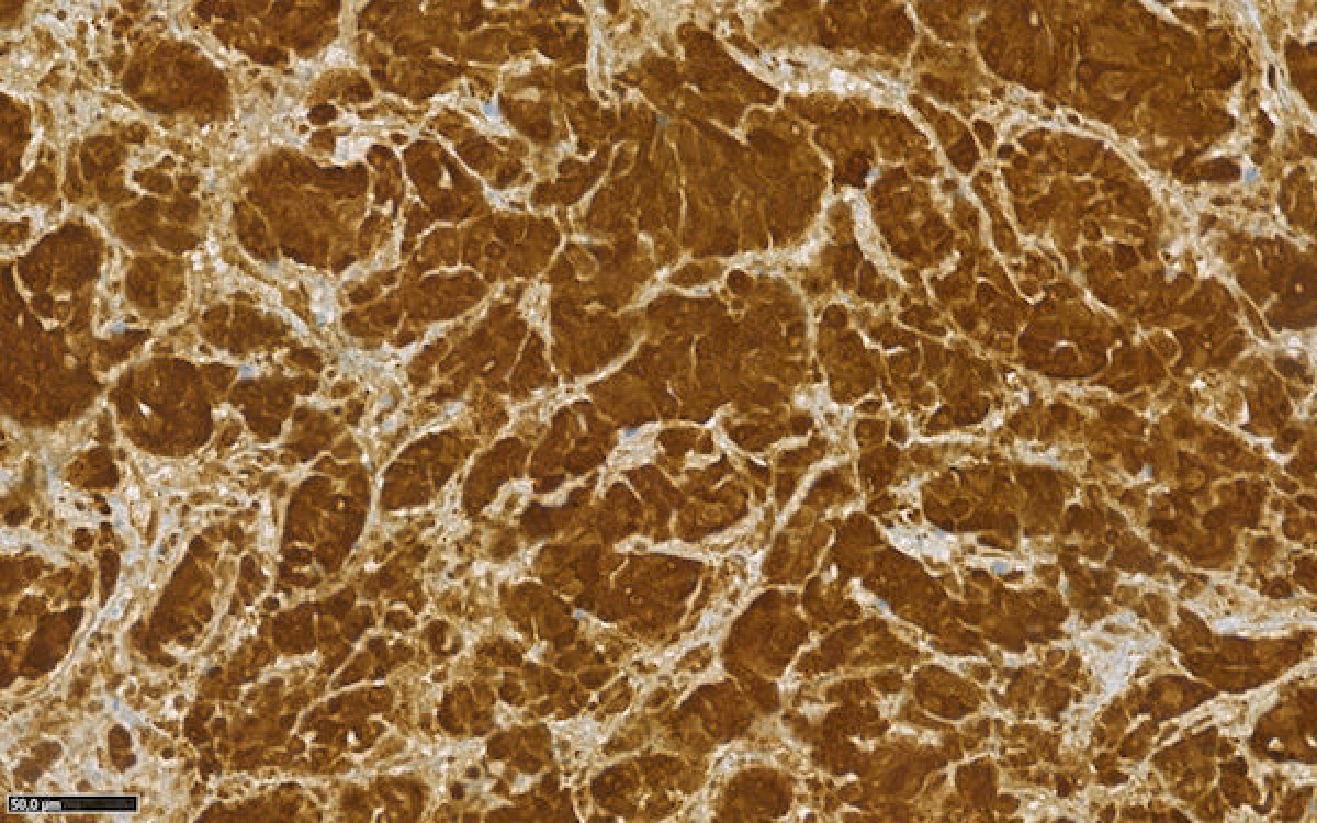 Histological image:immunohistochemistry with anti-cytokeratin antibodies 