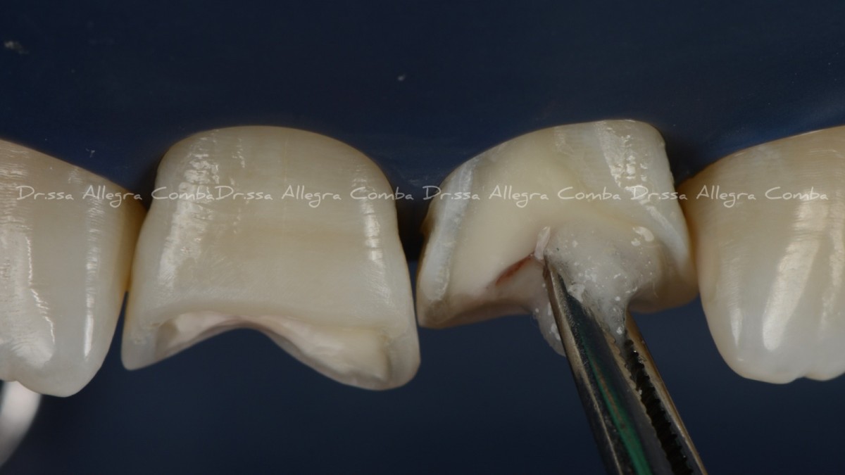Image 4: Adhesive procedures on premolars