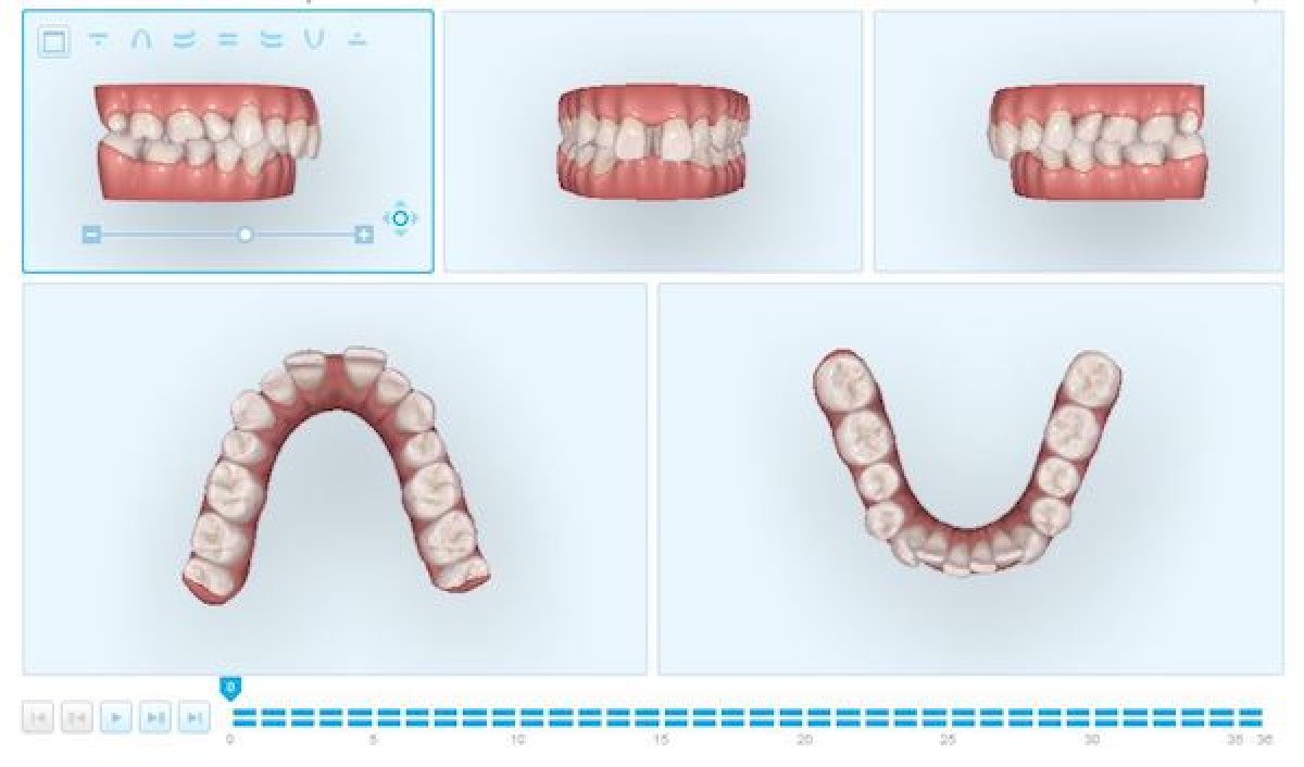 Figs. 7, 8 3D digital planning of the treatment. Movement was divided to 36 aligners (one week each