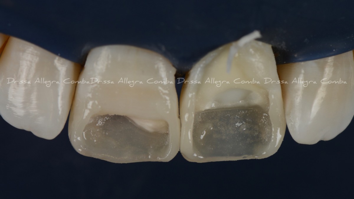 Image 7: Restorative procedures on premolars