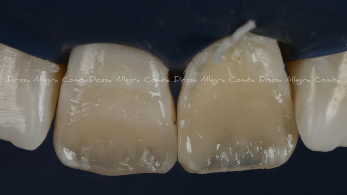 Image 8: Restorative procedures on premolars