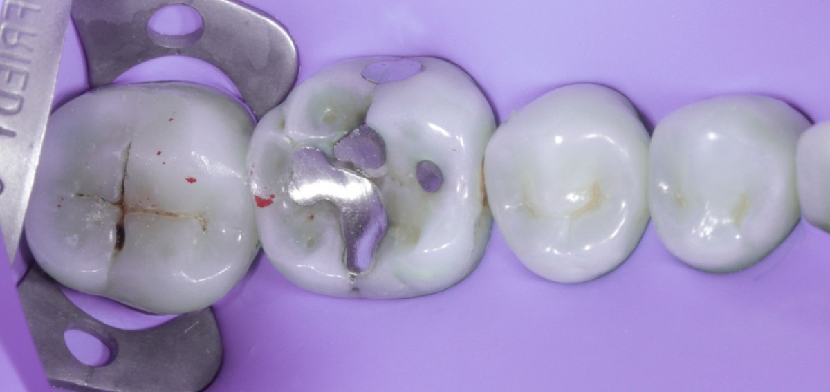 Fig 3 Clinical aspect after isolation with latex free rubber dam. Note the loss of some islands of enamel. These are probably the cause of discomfort and symptoms.