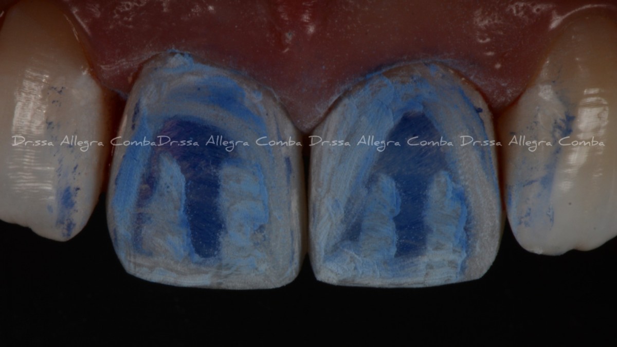 Image 9: Restorative procedures on premolars