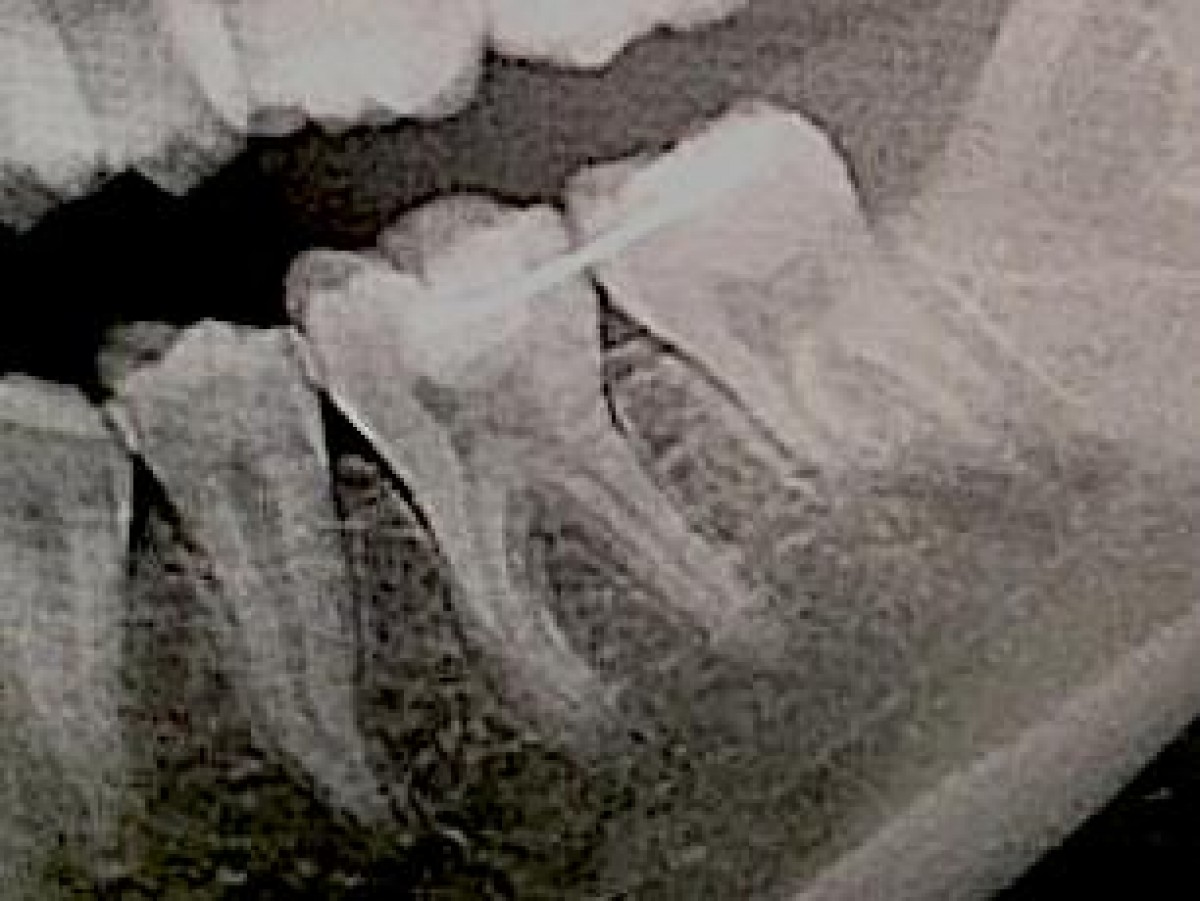 Fig 2: autotransplantation