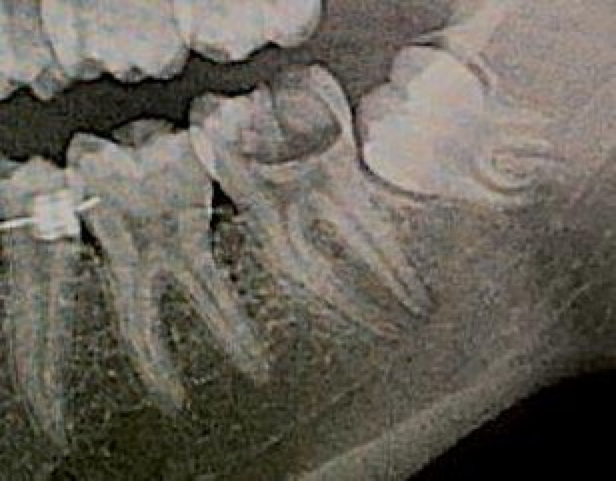 Fig. 1: dental caries