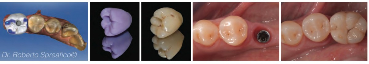 A digital workflow rehabilitation by Dr. Roberto Spreafico