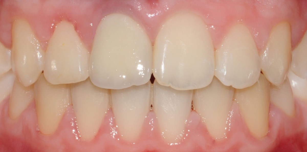 Final crown in zirconium-ceramic at element 1.1 level