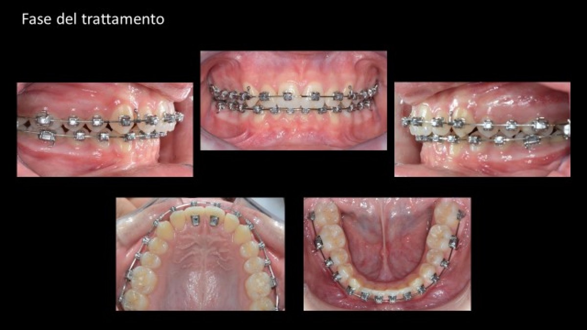 The digital workflow for personalised braces Dentistry33