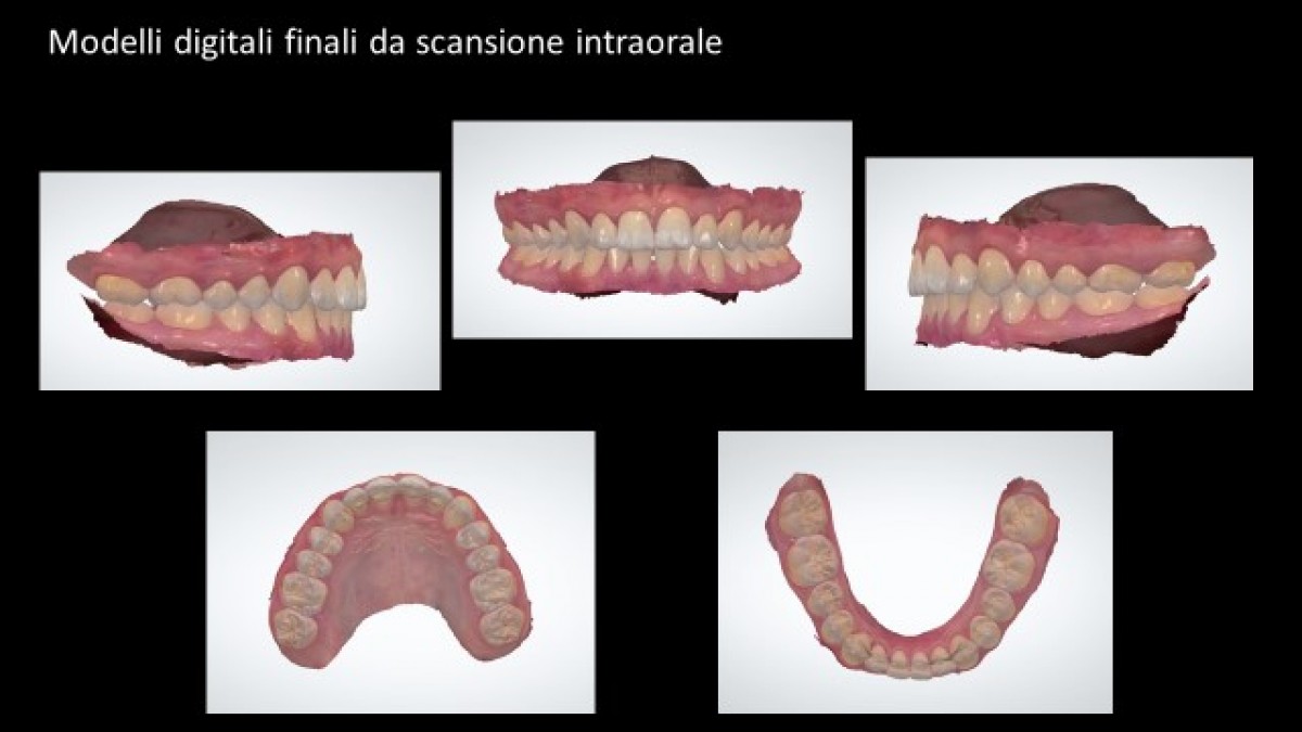 Final digital models from intraoral scan