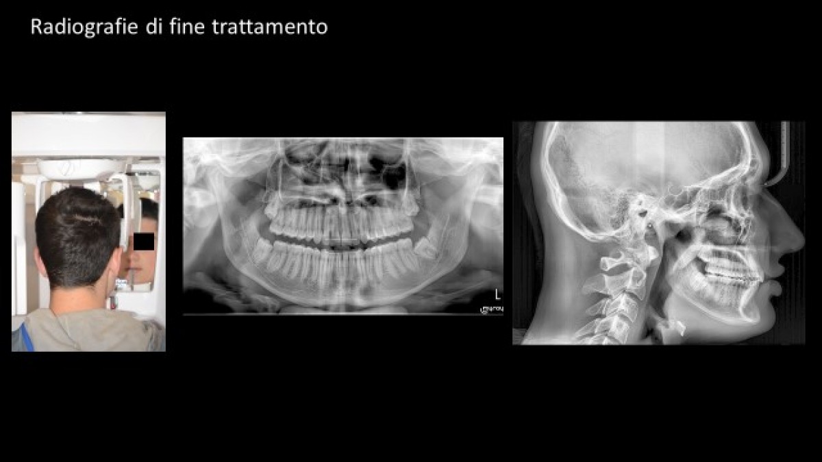 End-of-treatment X-rays