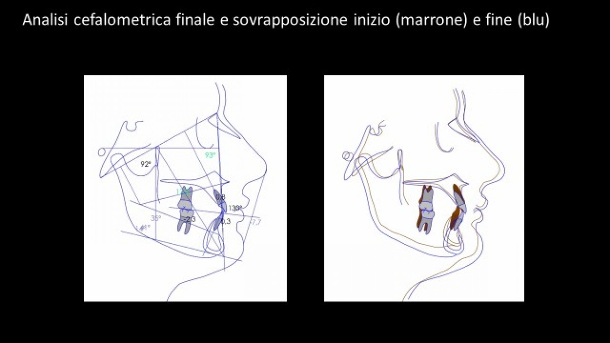 Final cephalometric analysis and overlap of start (brown) and end (blue) positions