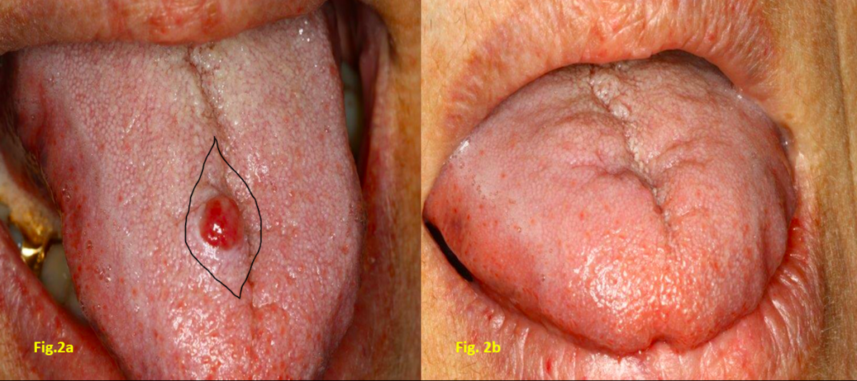 Figs. 2a-2b: The incision from the fusiform design (a); check about 4 weeks after the intervention (b)