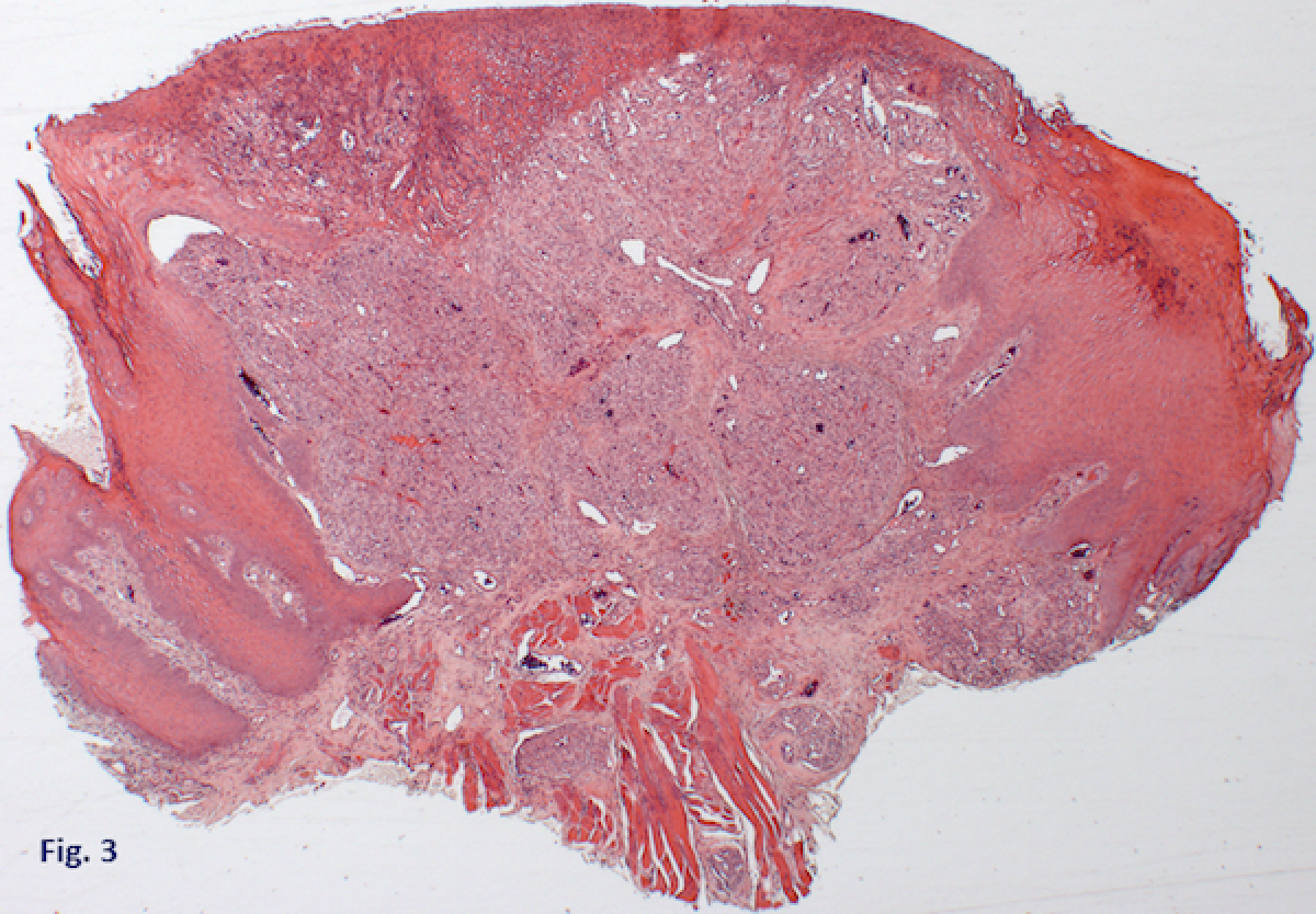Fig 3. Histological examination shows a predominance of vascular tissue