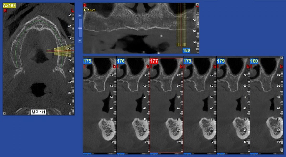 Virtual set-ups; Initial situation; Final desired occlusion