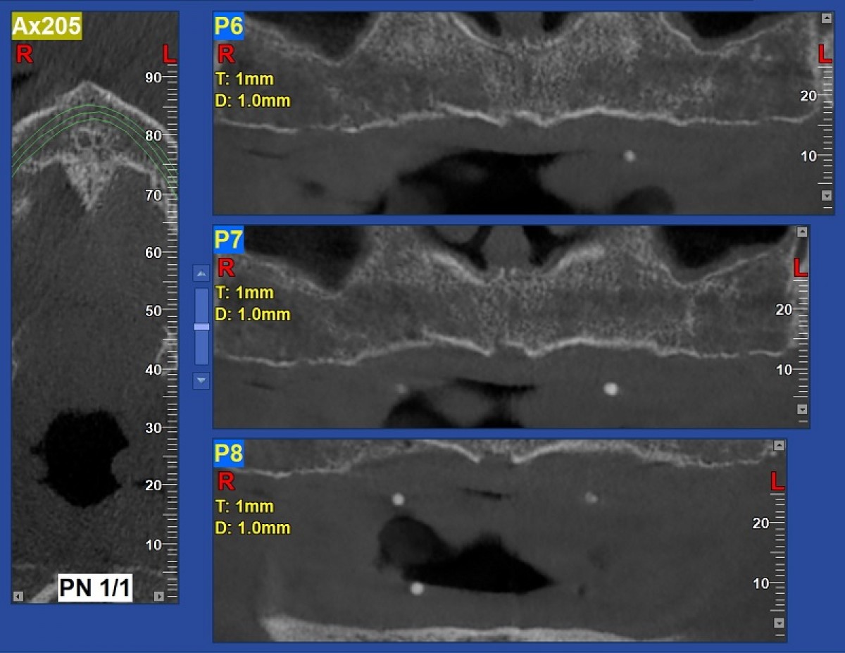 Virtual personalised brace; Positioning the brackets; Personalised arches