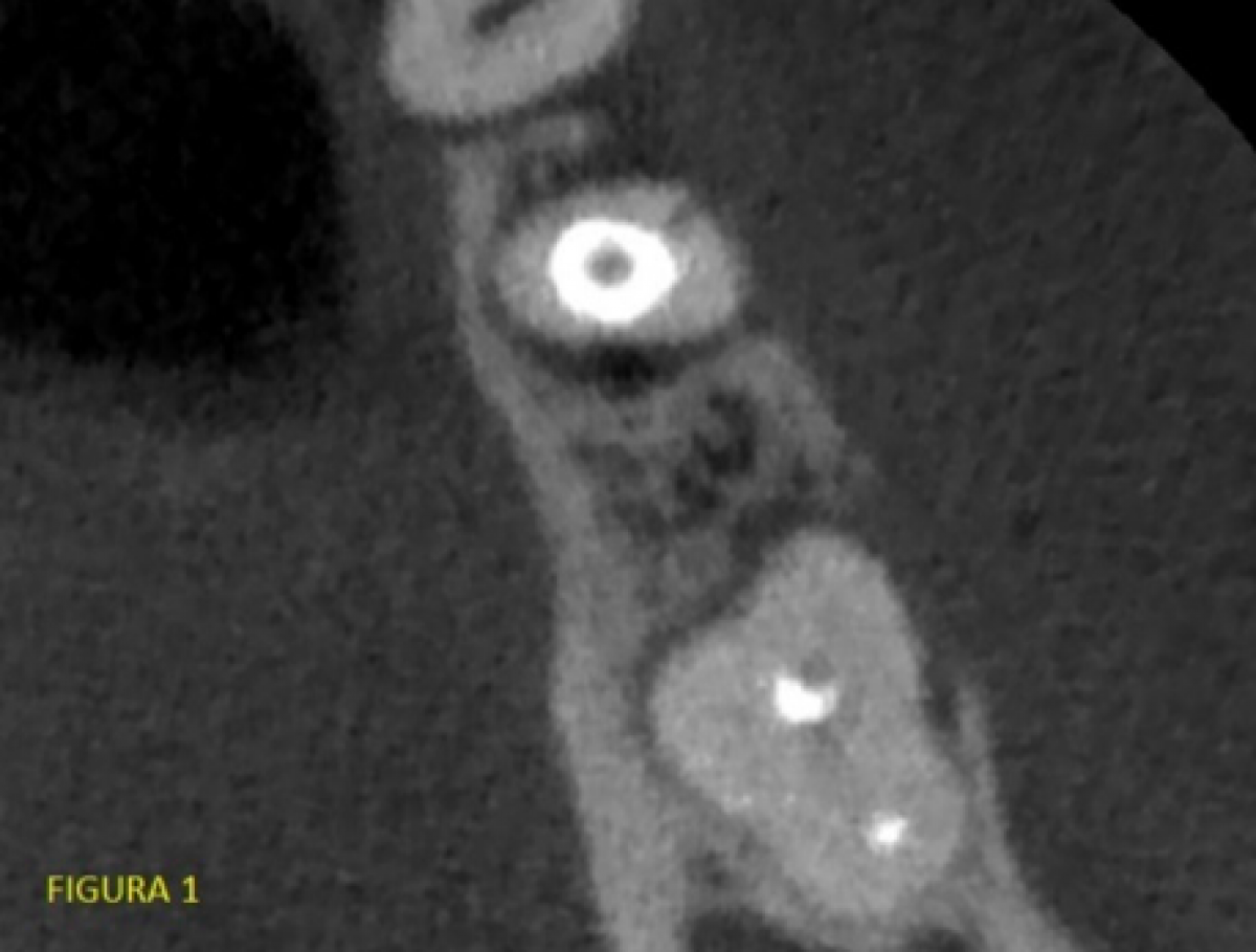 <p>                                    Fig. 1: longitudinal vestibular fracture highlighted.            <br></p>