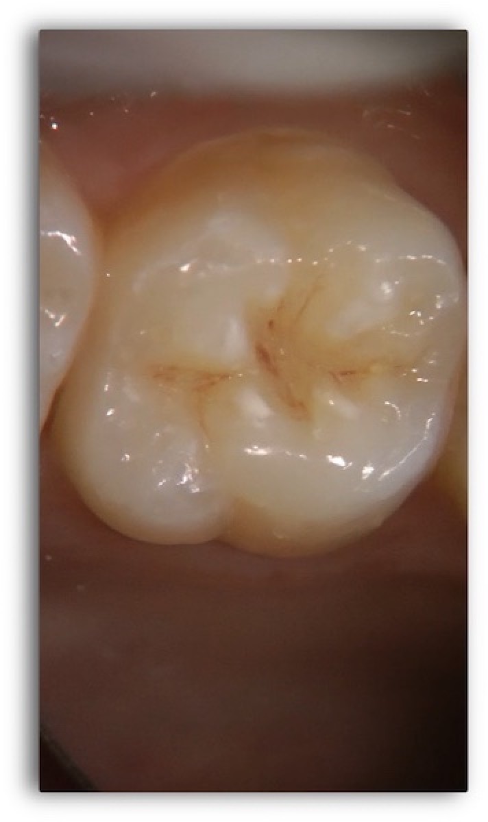 Restoration of endodontically treated molar a clinical case Dentistry33