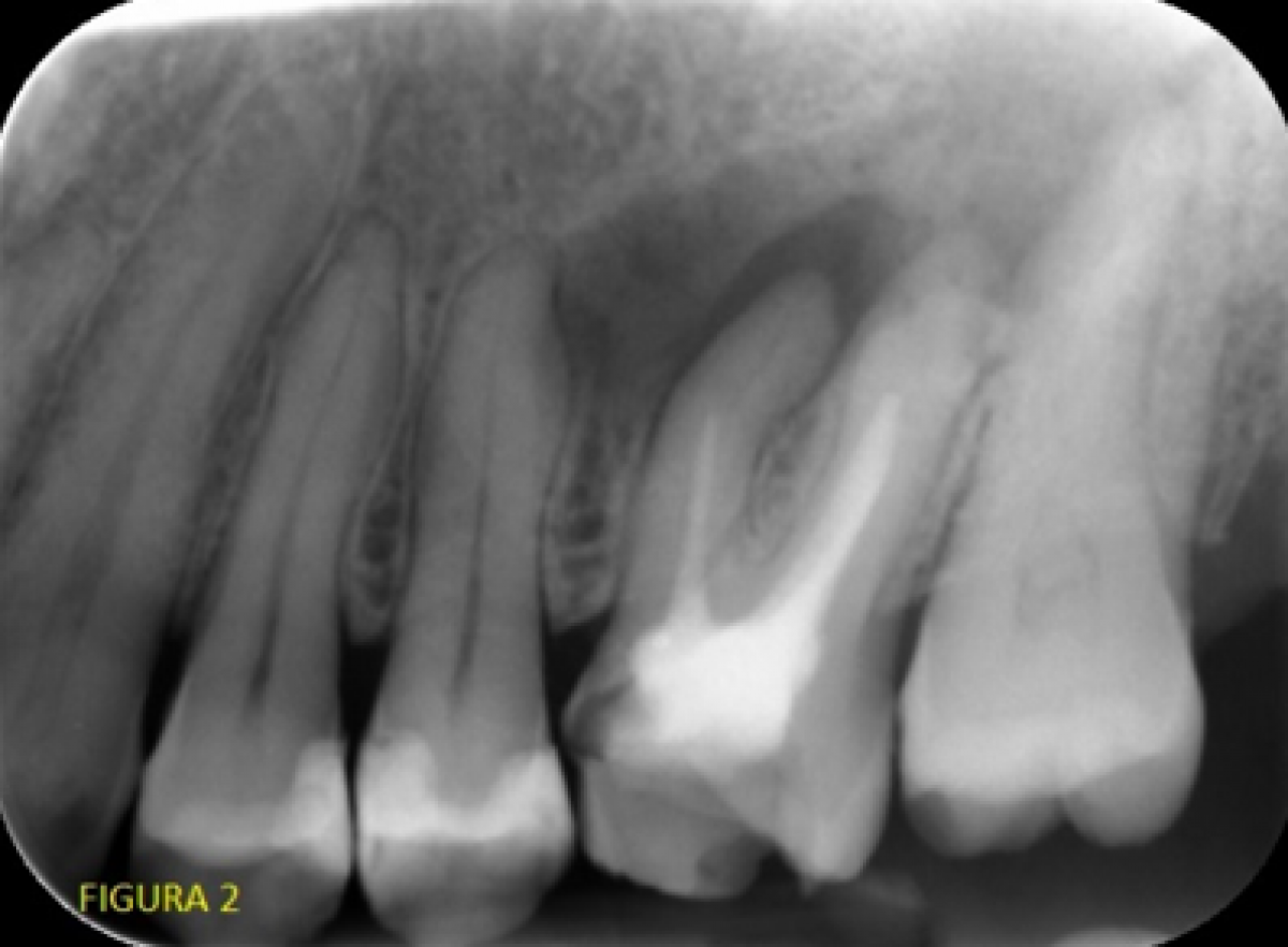 <p>                                    Fig. 2: Pre-op X-ray.            <br></p>