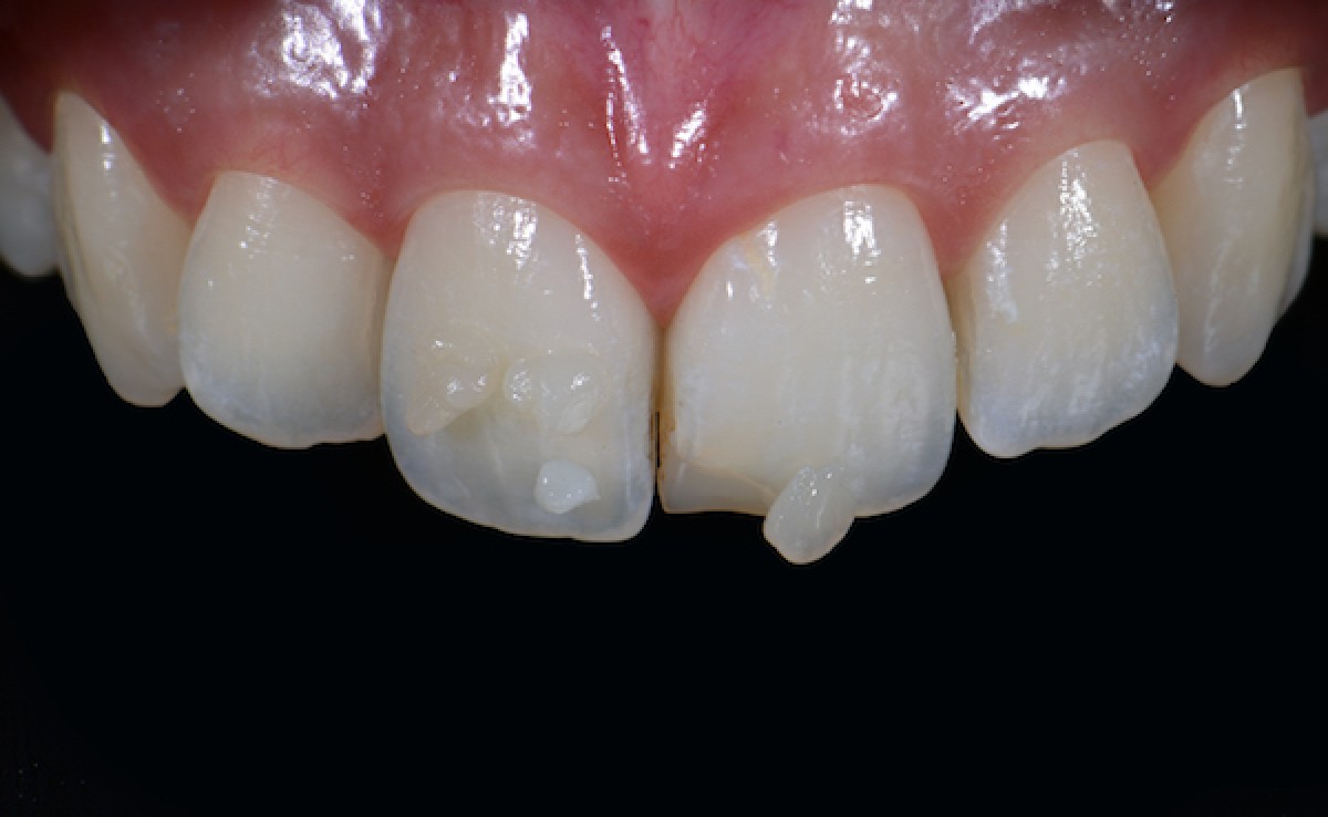 Fig 2: initial case 1.4 and 1.5 