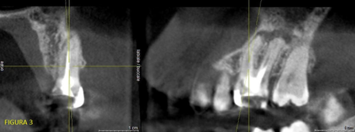 <p>                                    Fig. 3: 100-micron cross-sections made 4 years earlier. Note the  dimensions of the radio-transparency and lack of information on canal  morphology.            <br></p>