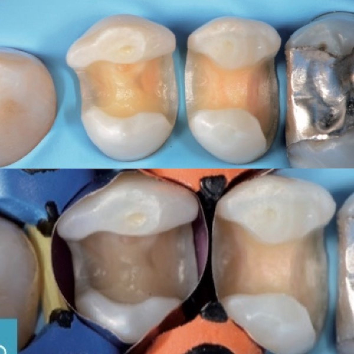 Fig 4a: Finished cavities 1.4 and 1.5; Fig 4b: sectional matrix positioning