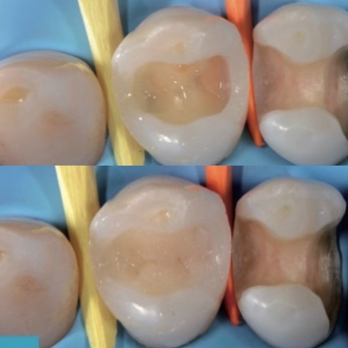 Fig 5a: interproximal walls reconstruction; Fig 5b: composite stratification